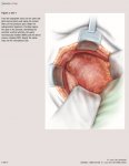 illustrated steps of radical cystectomy.jpg